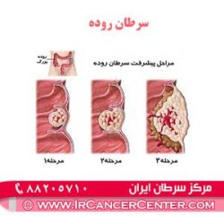 سرطان-روده-1 سرطان روده 1