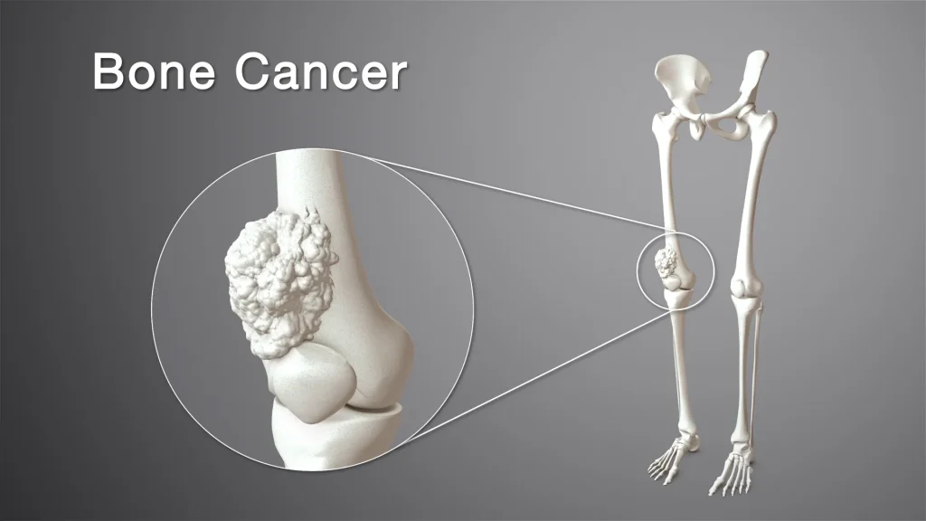 علائم سرطان استخوان